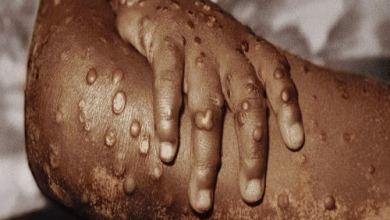 جدري القرود